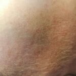 Facial Dermaplaning